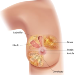 ¿Qué es el Cáncer de mama?
