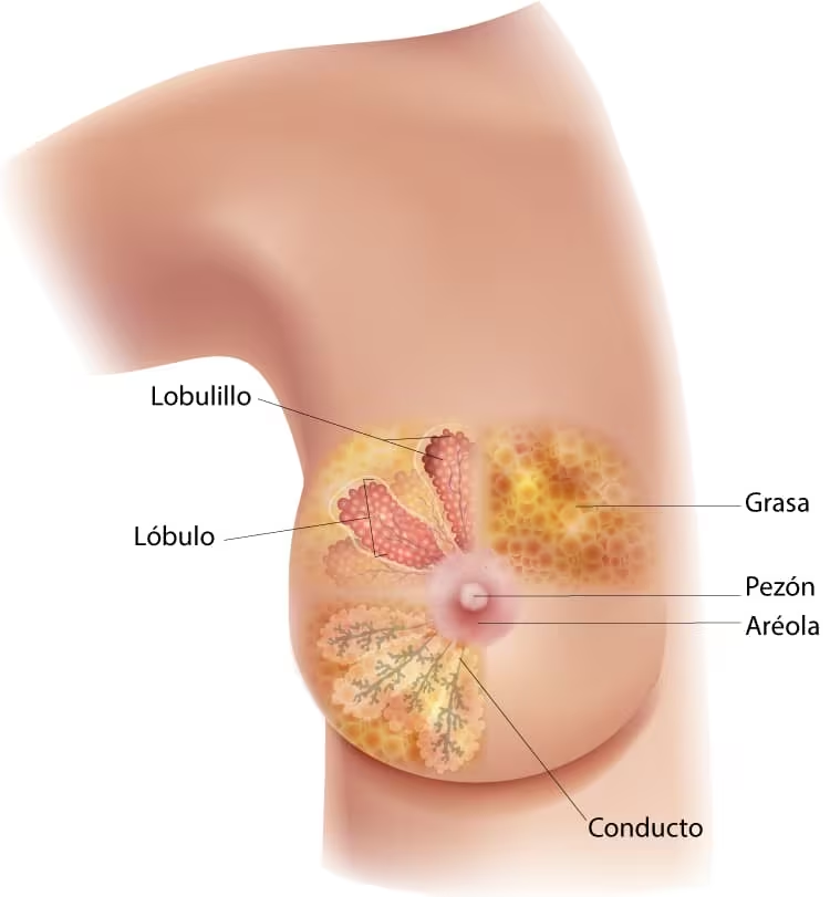 ¿Qué es el Cáncer de mama?