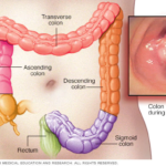 Cáncer de Colon